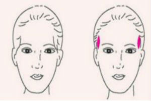 自体脂肪丰太阳穴效果怎么样?塑型填充恢复面部饱满形态